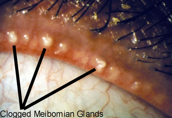 meibomian_glands_clogged_meibomian_gland_disease-resized-600